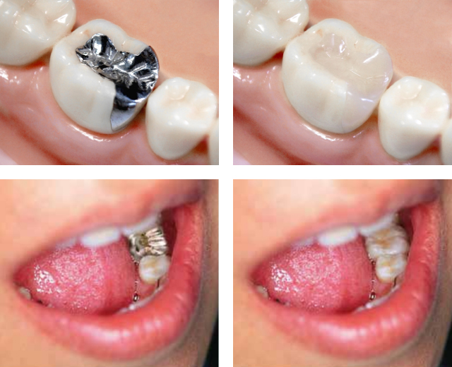 保険適応（条件あり）で白い歯が作れる